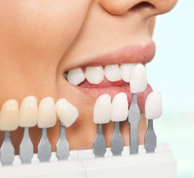 Dental Veneers- Veners EMAX 2D, Veners EMAX 3D