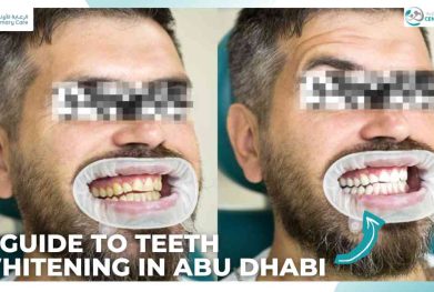 teeth Whitening in abu dhabi