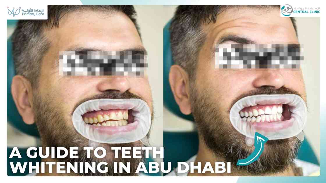 teeth Whitening in abu dhabi